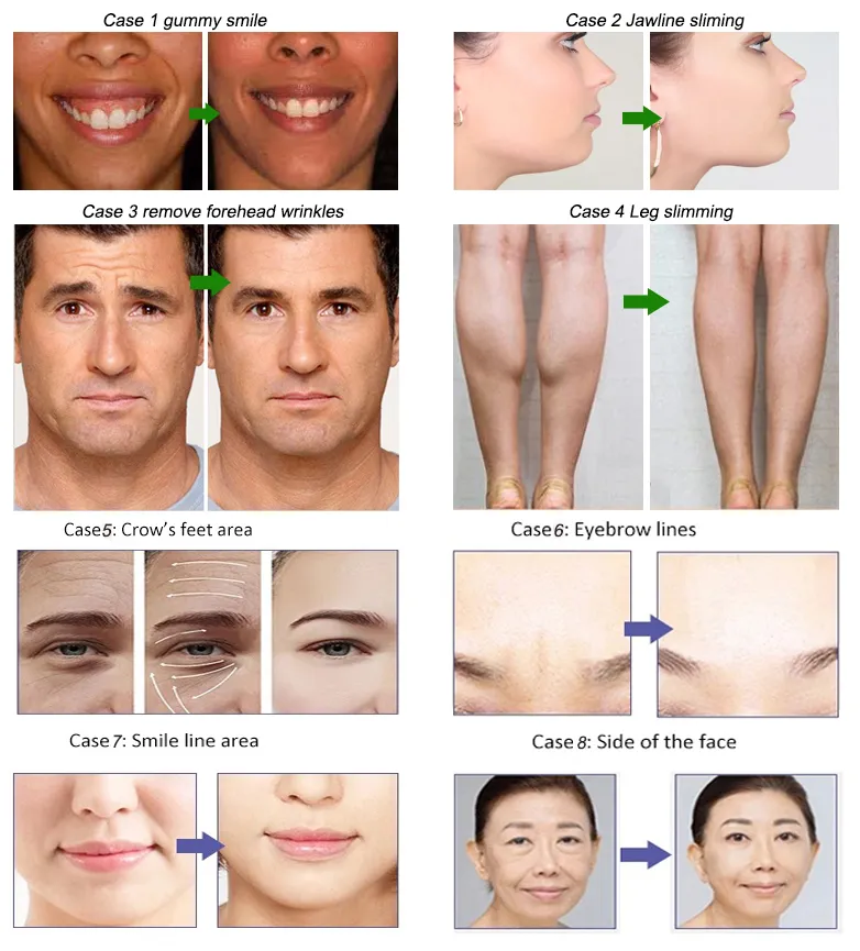 การลดความอ้วน Anti รอย Beutox Batulaxs รีสตี้ Dermal Filler Juvederms 1